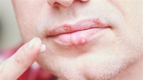 The bottom line. The herpes virus causes painful ulcers on the lips, inside the mouth, and on the genitals. It can also cause ulcers on the tongue. Herpes on the tongue is painful and takes at least a week to go away. Prescription medication can help tongue herpes heal faster, but it works better if you start it early.. 