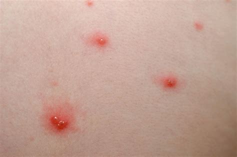 Symptoms of Anal Herpes. 1. Anal herpes blisters, are red bumps o