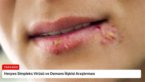 Herpes simpleks virüsü - Vikipedi