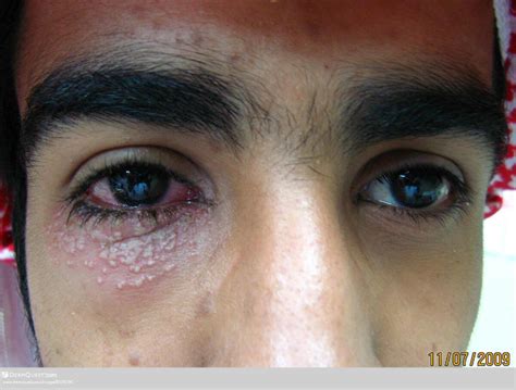 Herpes simplex eye infections: clinical manifestations, …