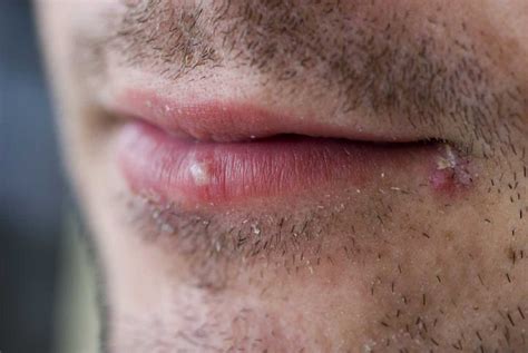 A herpes rash causes small bumps that turn into blisters or sores. Depending on the area infected with the herpes simplex virus (HSV), these may appear on the mouth, genitals, buttocks, and other areas. The rash can be painful. And while it can resolve, it can return over time because HSV never leaves the body.
