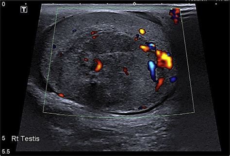 Heterogeneous hypoechoic lesion.  A large heterogenous vascular mass, ...