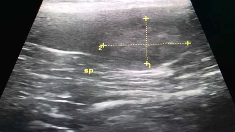 Heterogeneous hypoechoic lesion.  Certain patterns, such as Soft tissue masses are a commo...