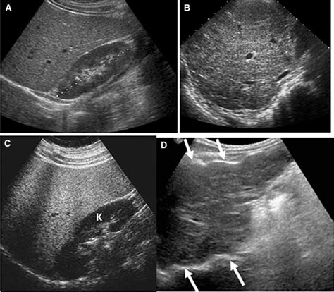 Heterogeneous liver on research ultrasound identifies children