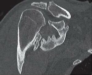 Heterotopic Ossification - Physiopedia