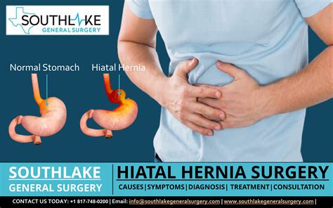 Hiatal Hernia Surgery - Division of Gastrointestinal Surgery