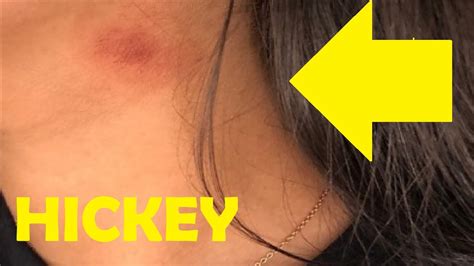 Hickeys porn. Things To Know About Hickeys porn. 