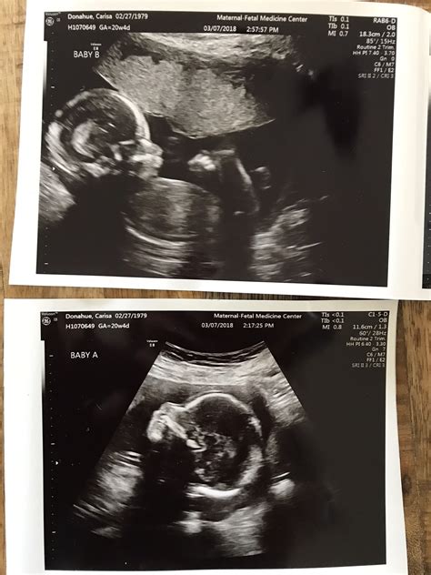 Hidden twin ultrasound 20 weeks. Fraternal twins depends on how many eggs the female releases. Has nothing to do with males. Like. 1. 19sarahk86. Jan 8, 2018 at 3:52 PM. There’s only 1. If there was 2, then second one would look like the first one, and there’s only the 1 that looks like that. The other is either a shadow or the placenta or something. 