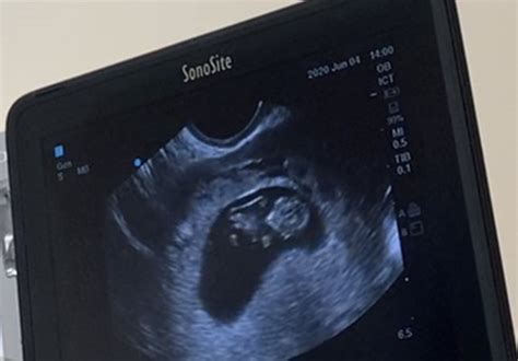 Hidden twin ultrasound 30 weeks. Advertisement Consider the following story: My identical twin sister, nicknamed 