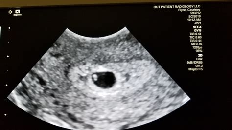 Hiding twin ultrasound. Identical twins, when one embryo was formed and split into two, usually develop in the same gestational sac but have separate fetal poles and yolk sacs. Can an ultrasound miss twins at 7 weeks? Twins can be missed at 7 weeks or at any gestation. It’s hard to believe but one gestational sac can hide behind another. 