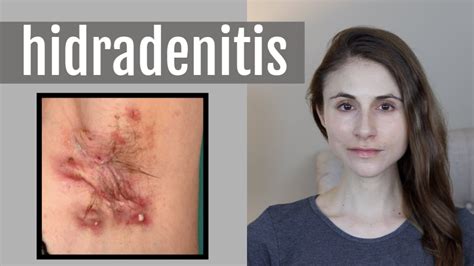 Hidradenitis suppurativa reddit. 27 Jun 2022 ... 65 votes, 56 comments. 32K subscribers in the Hidradenitis community. This subreddit is a community of people who suffer from Hidradenitis… 