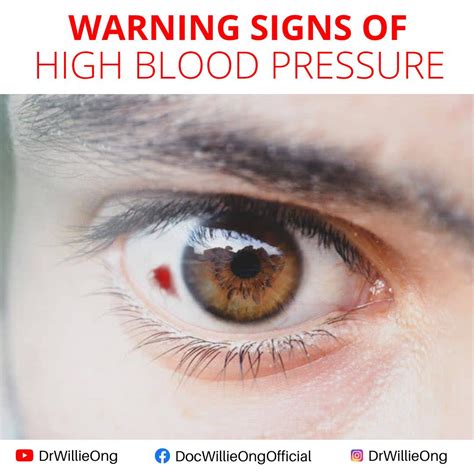 High blood pressure and eye disease - Mount Sinai Health …