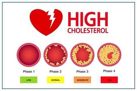 High cholesterol in athletes What to know