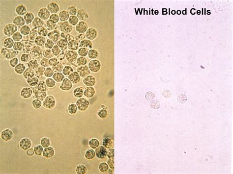 High false positive rate of white blood cells in urine samples of ...