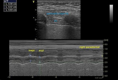 High parasternal intercostal muscle thickening prior to …