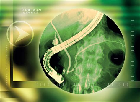 High-dose NSAIDs and pancreatitis after ERCP: more is …