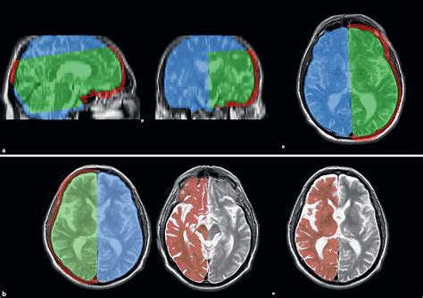 High-grade internal carotid artery stenosis and chronic brain …