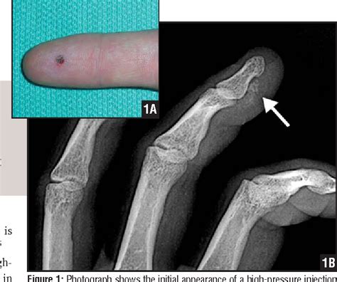 High-pressure injection injuries to the hand - PubMed