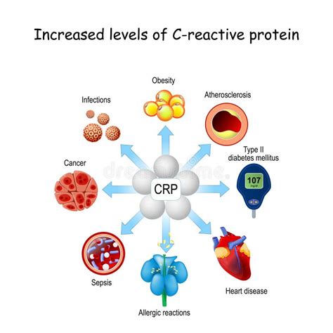 High-sensitive C-Reactive Protein as a Marker for Inflammation in ...