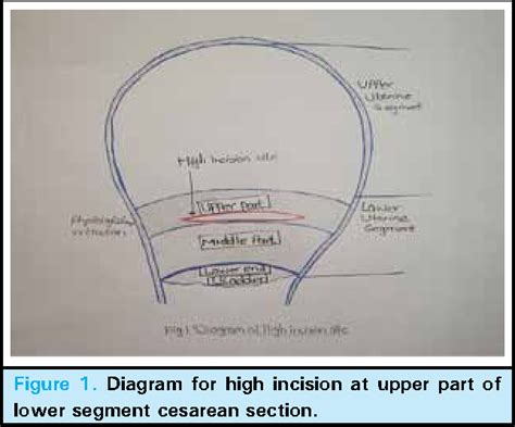 Higher Incision at Upper Part of Lower Segment …