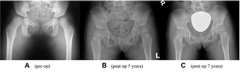 Hip Development after Selective Dorsal Rhizotomy in Patients with ...