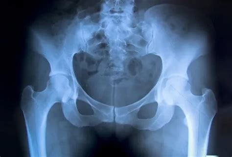 Hip Picture Image on MedicineNet.com