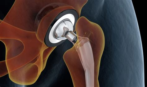 Hip and knee surgery a patientaposs guide to hip replacement hip resurfa. - Souverainete  des peuples dans leurs f^etes publiques.