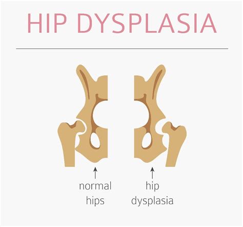 Hip dysplasia is not a sentence – Healthy Food Near Me