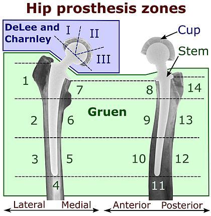 Hip prosthesis zones - Wikipedia