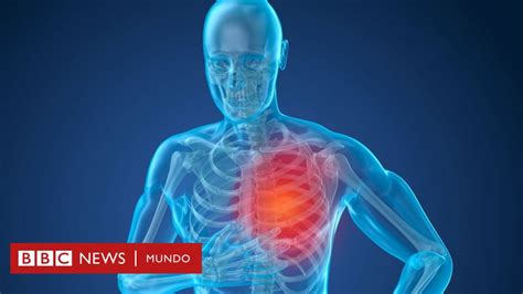 Hipertensión BBC