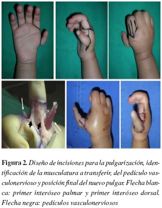 Hipoplasia del pulgar (para Padres) - Nemours KidsHealth