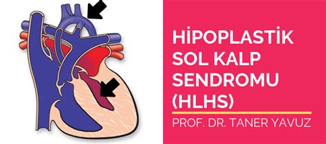 Hipoplastik sol kalp sendromu