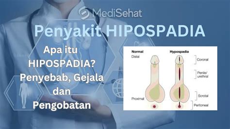 Hipospadia – Penyebab, Gejala, Diagnosa, Bahaya dan …