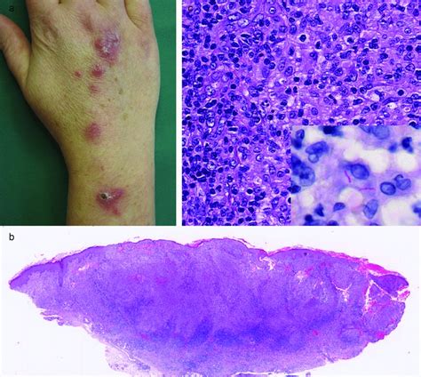 Histologic features of granulomatous skin diseases - Mitteldorf