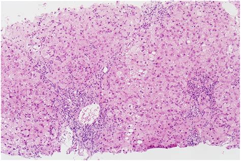 Histologic scoring systems for chronic liver disease