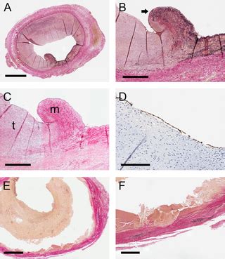 Histological Analysis of Extracranial Carotid Artery Aneurysms