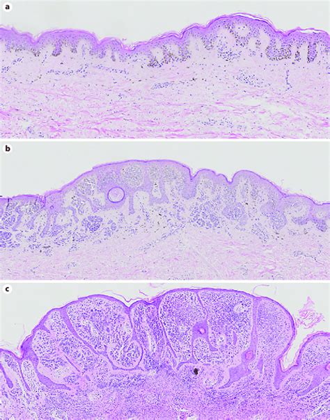 Histopathological Characteristics and Classification for …