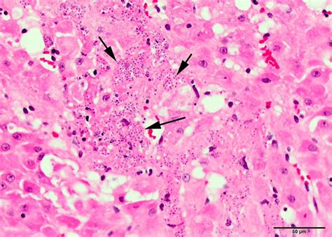 Histoplasmosis - Generalized Conditions - Merck …