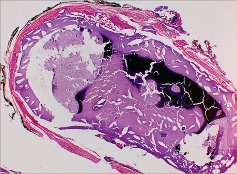 Histoplasmosis Mimicking Malignant Adenopathy - JAMA