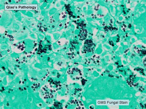 Histoplasmosis of the Colon Flickr