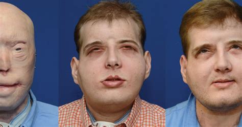 Historic face transplant recipient doing well four years later