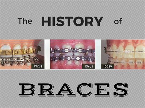 History of Braces: Who Invented Braces?