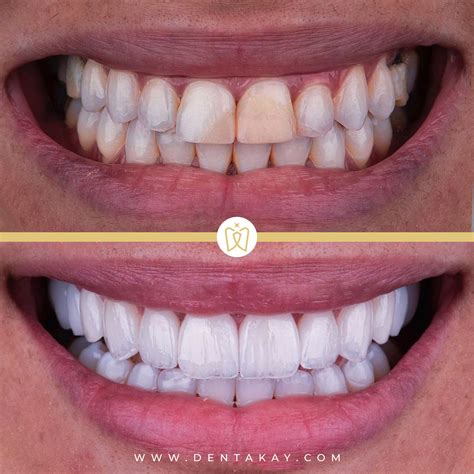Hollywood smile dental. Hollywood Smiles offer the most advanced technology in cosmetic dentistry. Lumineers, Invisalign, Cerec, Sapphire In-Office Power Teeth Whitening, Porcelain Veneers and Full Porcelain crowns are some examples of how we re-design our patients’ smiles. 
