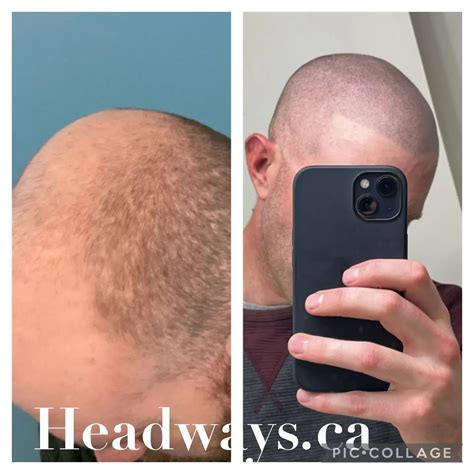 Home - Headways Scalp Micropigmentation SMP in …