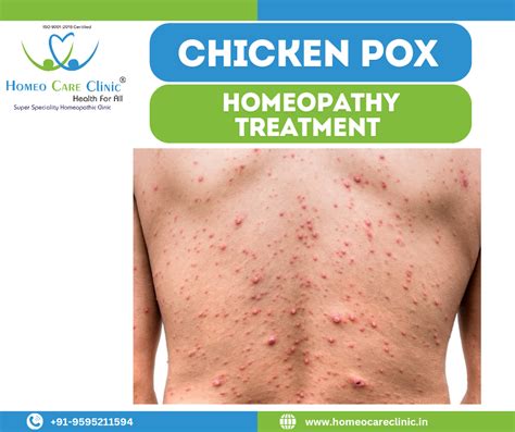 Homeopathy For Chickenpox