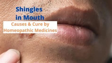 Homeopathy for Shingles - Symptoms, Causes & Best 10 Remedies