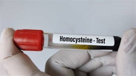 Homocysteine Testing and its Use in Treating Fertility Issues