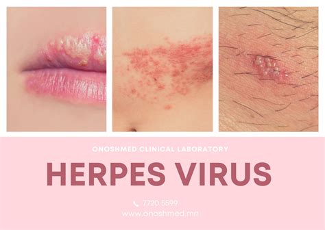 Honeycomb herpes symptoms. Undiagnosed asking for symptoms. By Cppleet February 5, 2022 in Herpes Veterans. Share 