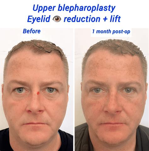 Hooded eyes operation