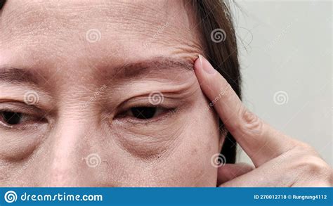 Horizontal Forehead Lines: A Reflection of Eyelid Ptosis or